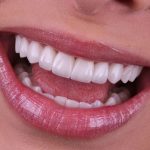 lentes de contato dental em Joinville SC sorriso perfeito