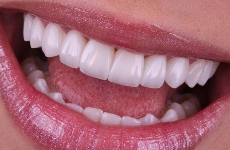 lentes de contato dental em Joinville SC sorriso perfeito