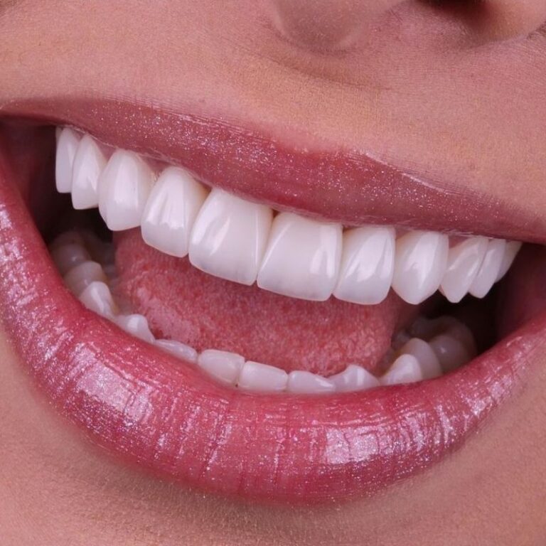 lentes de contato dental em Joinville SC sorriso perfeito